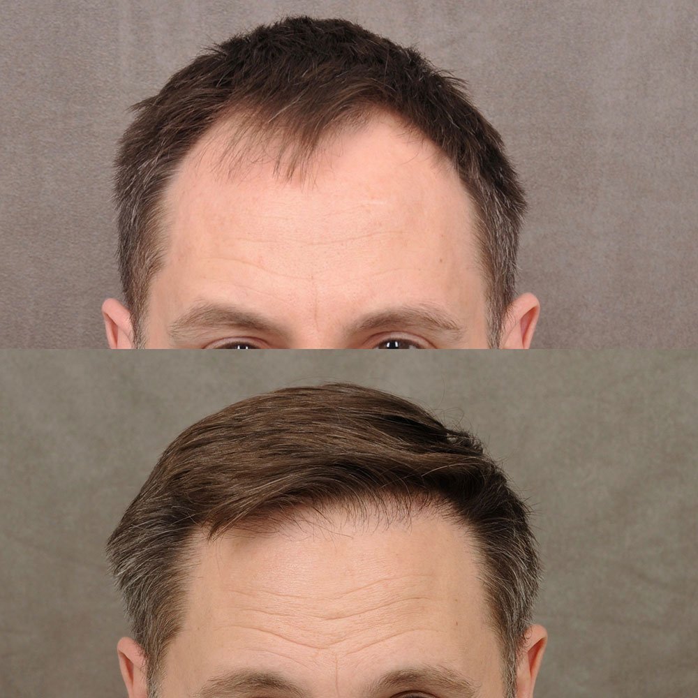 FUE-hair-transplant-3-2.jpg FUE-hair-transplant-3-2.jpg